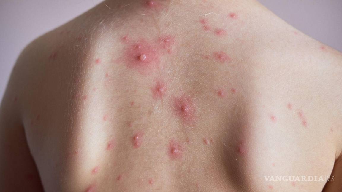 ¿Sabes cómo prevenirla? Suben 31 por ciento casos de varicela en Coahuila