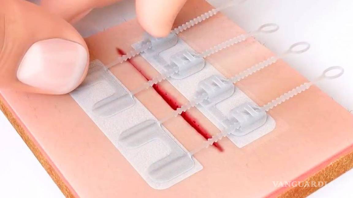 ZipStitch, con este dispositivo podrás cerrar heridas sin sutura