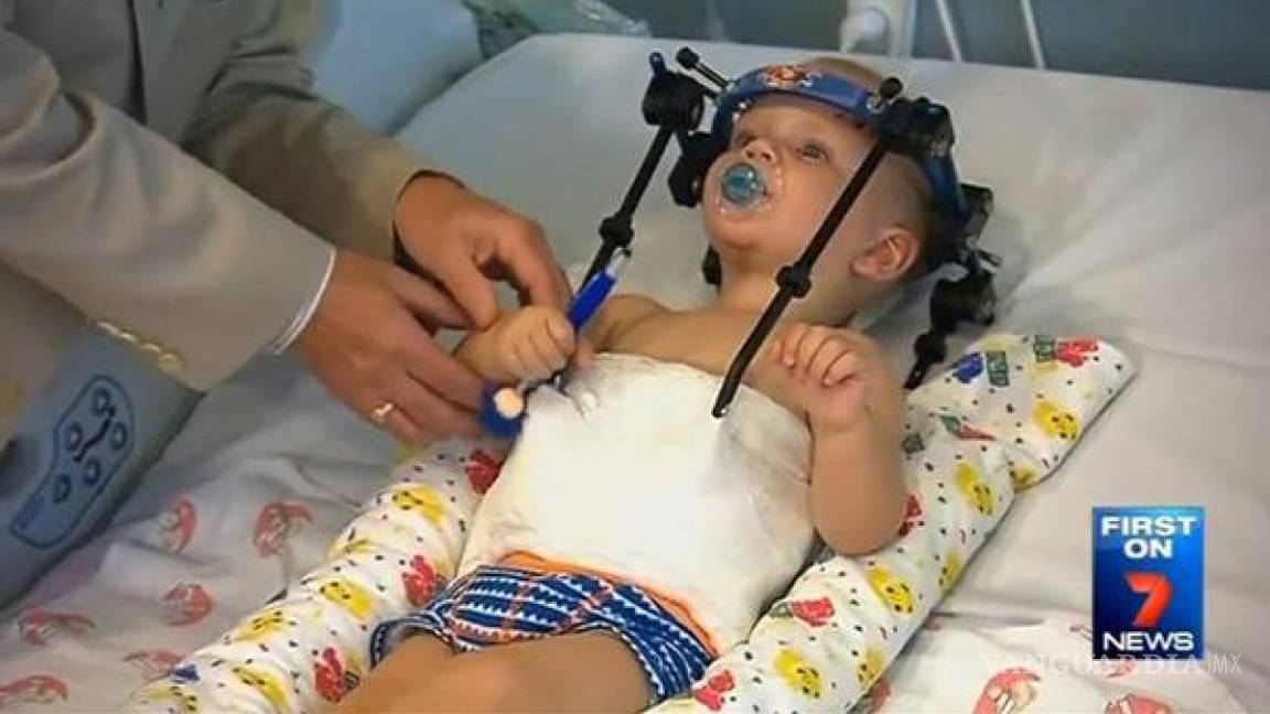 Médicos salvan a bebé decapitado al unir su cabeza con la columna