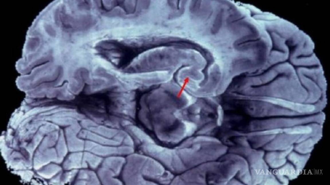 Se puede diagnosticar Alzheimer hasta con 10 años de anticipación
