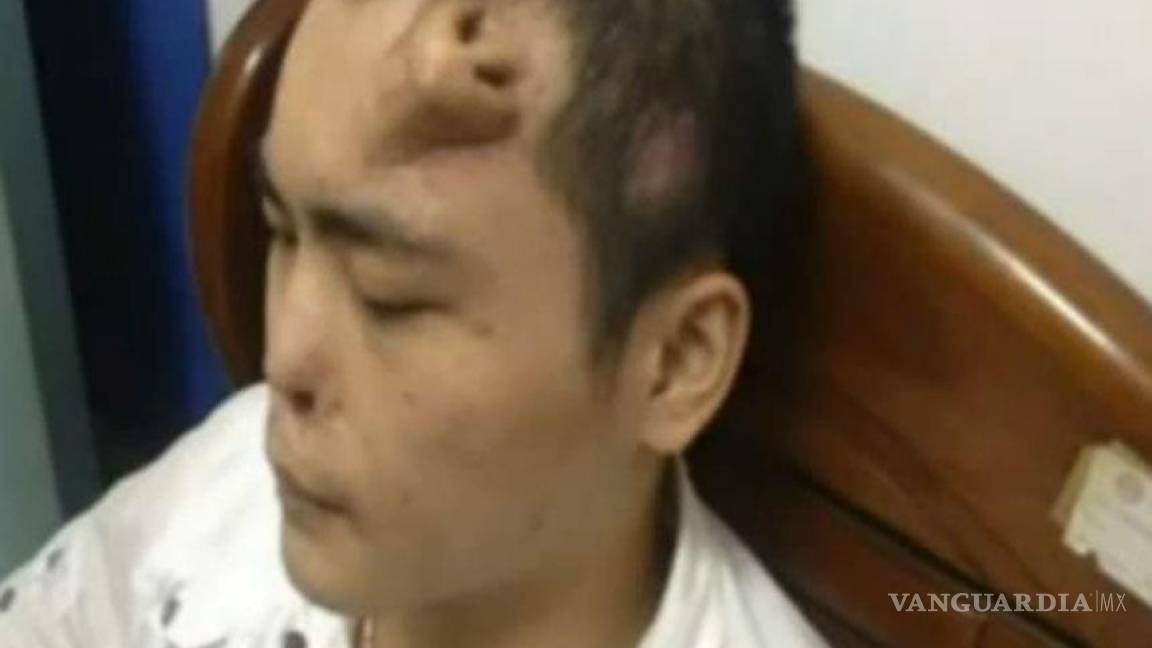'Crece' nariz en la frente de un joven en China