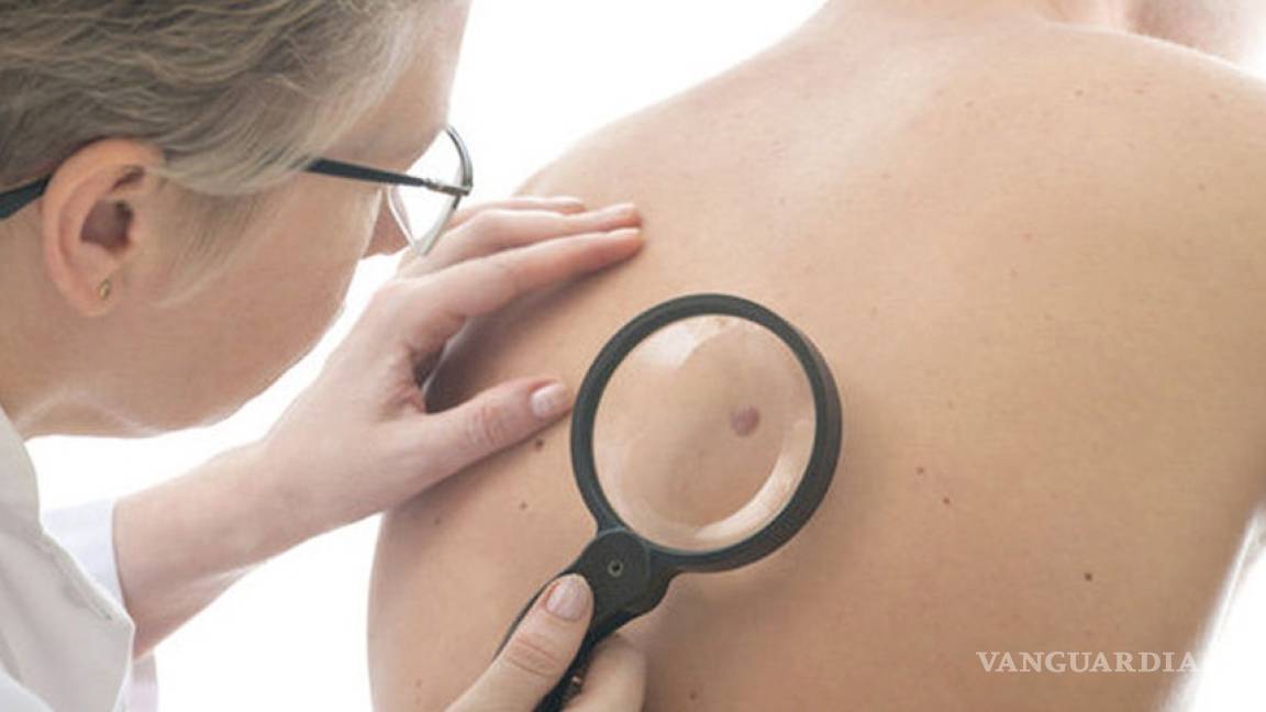 En México es más frecuente que hombres padezcan cáncer en la piel