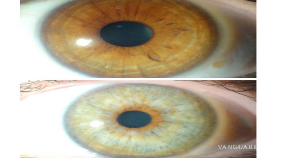 Un tratamiento con láser modificar el color del iris