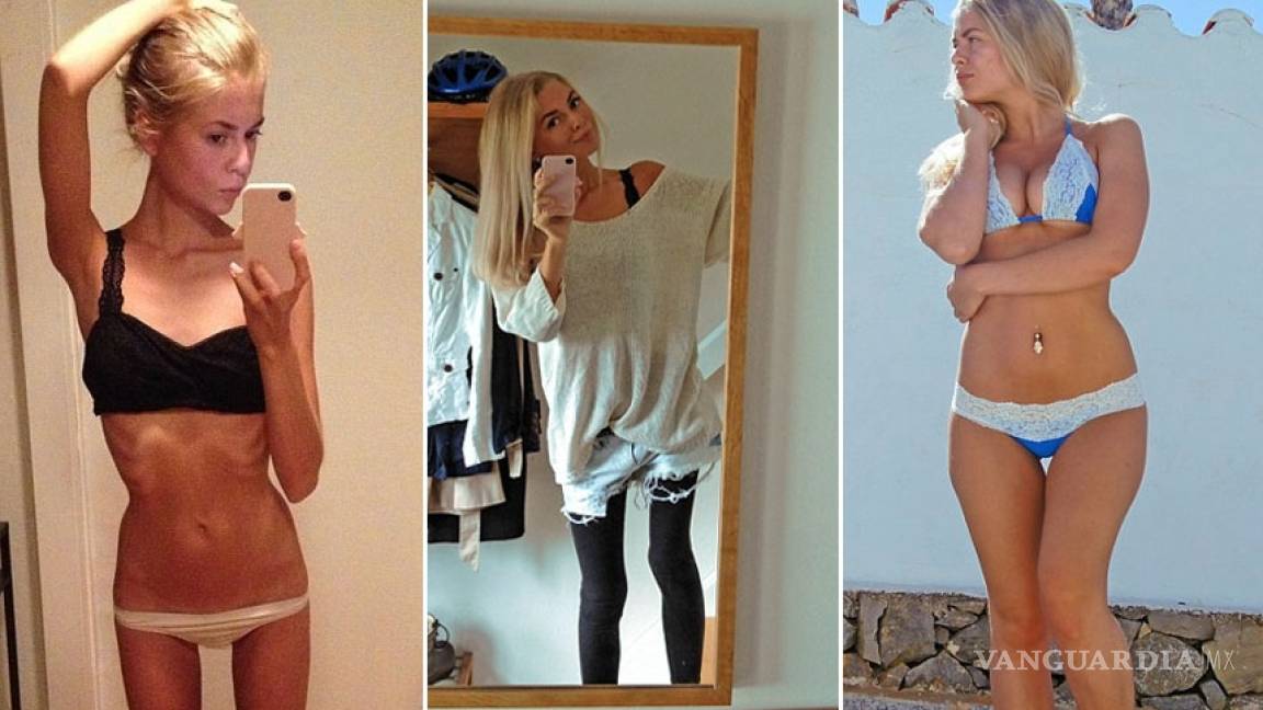 Joven muestra en Instagram su batalla contra la anorexia