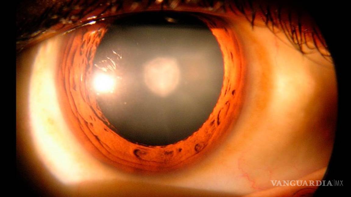 En millonésimas de segundo, tecnología de Centro Conacyt podría medir presión en ojo