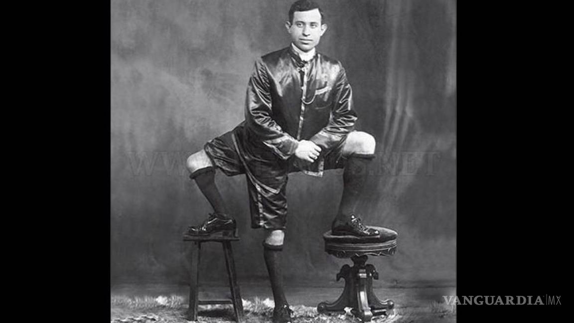 Francesco Lentini, el hombre que nació con tres piernas y dos penes