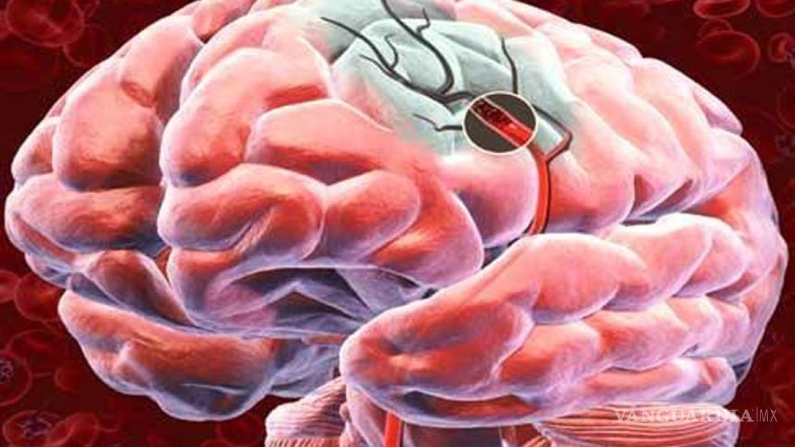 Edad avanzada, factor de riesgo para sufrir accidente cerebrovascular