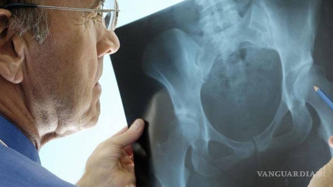 Osteoporosis, una grieta en los huesos