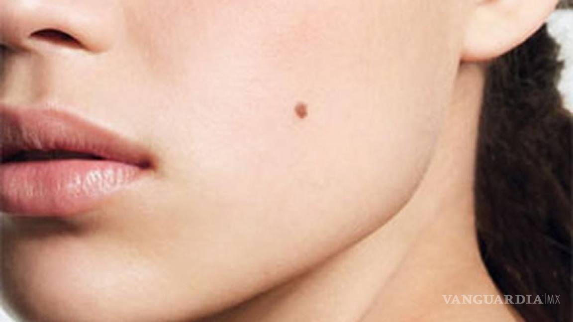Lunares, clave en la prevención de cáncer de piel