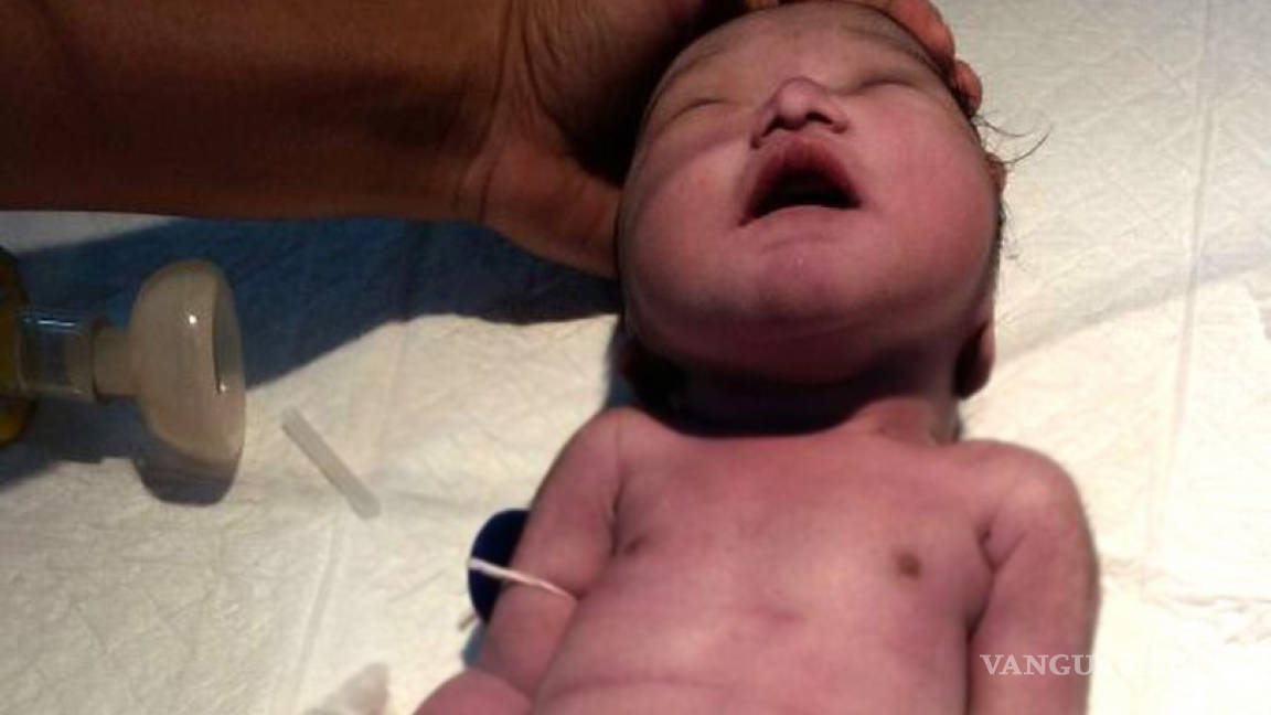 Madre da a luz a 'bebé sirena', pero éste muere cuatro horas después