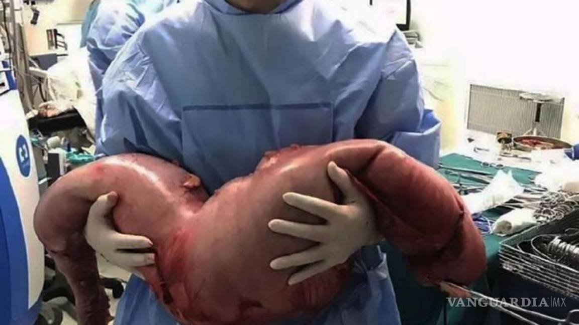 Retiran 13 kilos de heces de un hombre estreñido con cirugía