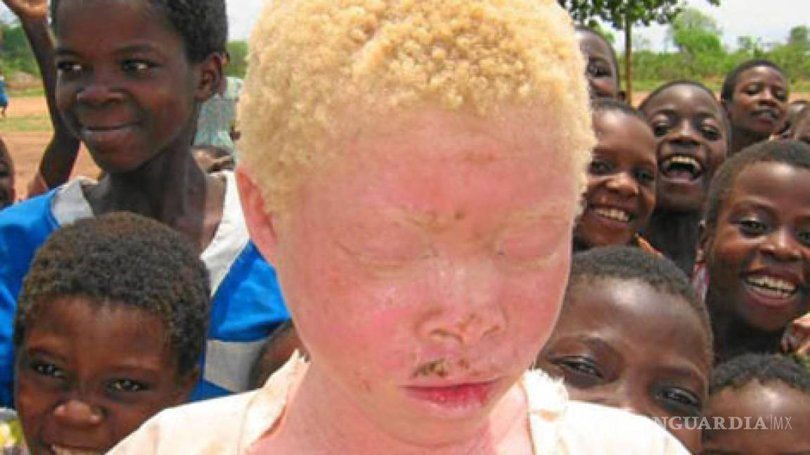 En Tanzania violan y asesinan personas albinas &quot;para curar el sida&quot;
