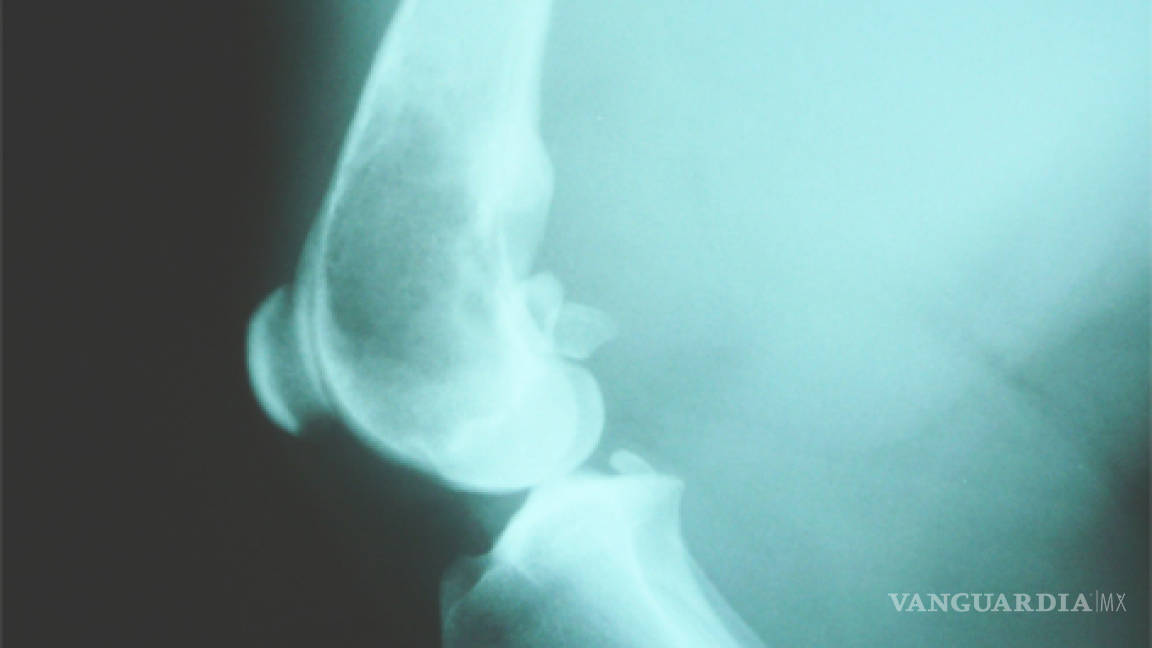 Riesgos y síntomas del Osteosarcoma