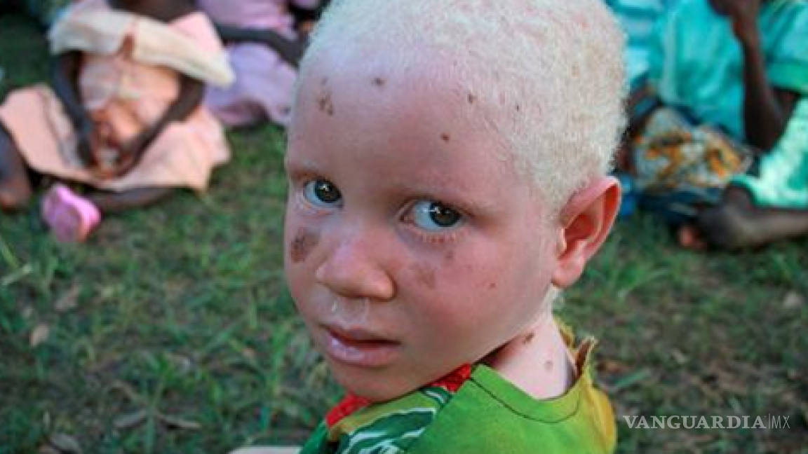 Albinos vulnerables a padecer cáncer