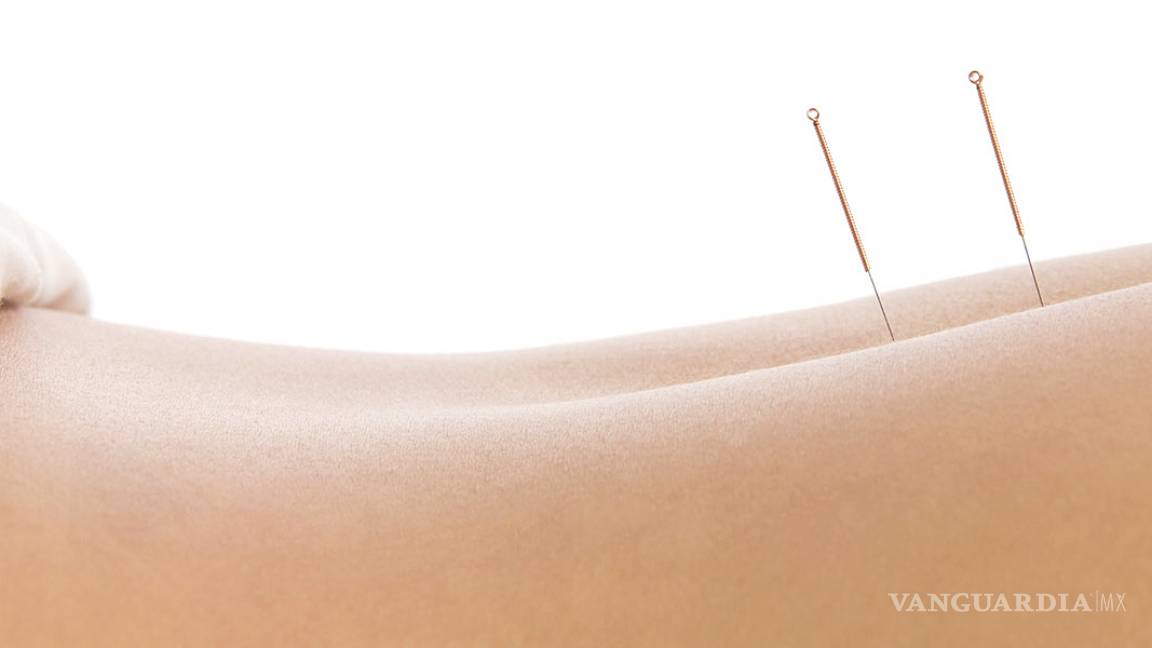 Todo lo que tienes que saber sobre la acupuntura (y sanar dolores)