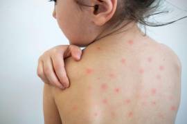 El sarampión puede ser mortal especialmente en niños no vacunados