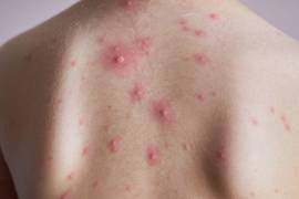 La varicela es una enfermedad común en la niñez, altamente contagiosa, causada por el virus varicela-zoster. Los síntomas incluyen fiebre, dolor de cabeza y erupciones cutáneas.