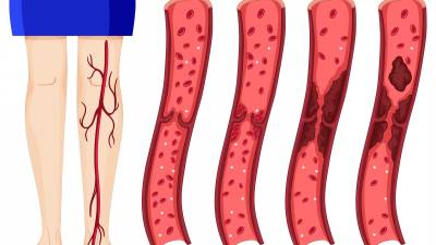 La trombosis es una condición médica grave que se produce cuando se forma un coágulo de sangre en una vena o arteria.