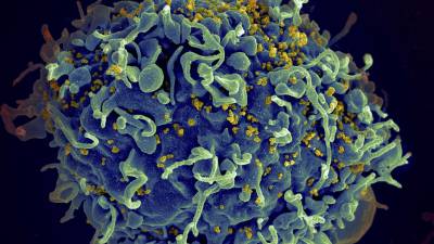 Esta imagen de microscopio electrónico proporcionada por los Institutos Nacionales de Salud de Estados Unidos muestra una célula T humana, en azul, atacada por el VIH, en amarillo, el virus que causa el SIDA.