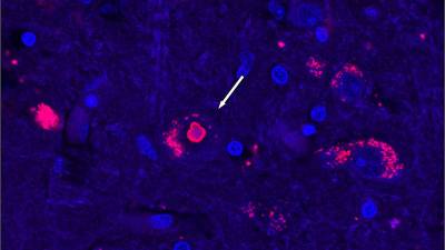 Tejido cerebral de un paciente con SCA4. El azul marca el ADN celular y el rojo marca una proteína que aumenta cuando se interrumpe el reciclaje de proteínas.