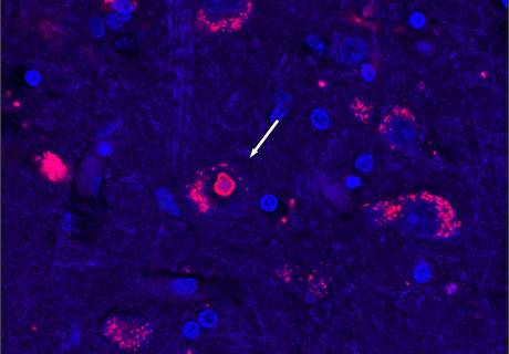 Tejido cerebral de un paciente con SCA4. El azul marca el ADN celular y el rojo marca una proteína que aumenta cuando se interrumpe el reciclaje de proteínas.