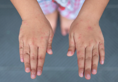 En lo que va del año se registran siete brotes; se aplican medidas preventivas por aula y no se cierran escuelas En lo que va del año se registran siete brotes; se aplican medidas preventivas por aula y no se cierran escuelas