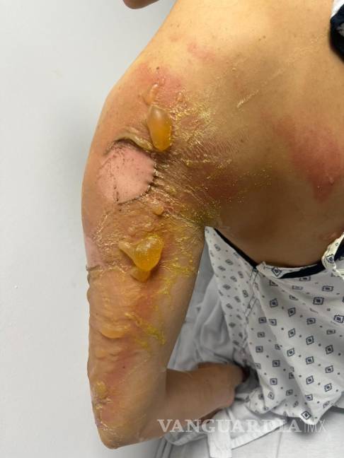$!A través de redes sociales, se compartieron imágenes de asistentes que sufrieron quemaduras y lesiones.