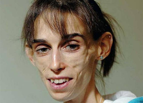 Muere La Mujer Con El Peor Caso De Anorexia En El Mundo