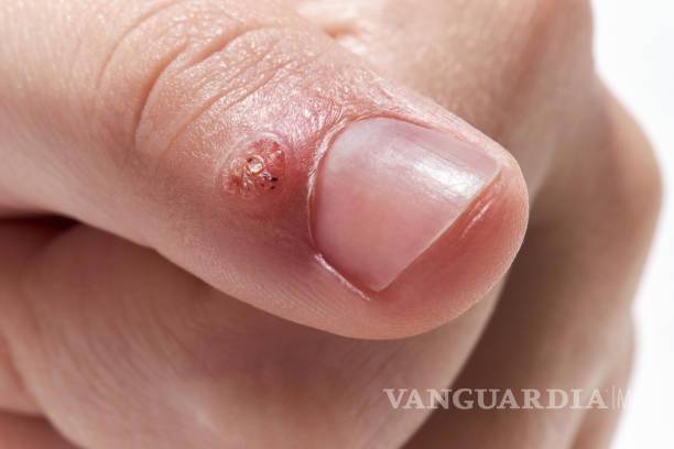 $!Estas molestas lesiones pueden surgir en diversas partes del cuerpo, como dedos, manos, brazos, cuello y cara.
