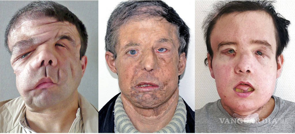 $!Por primera vez en la historia un hombre pasa por dos trasplantes de cara