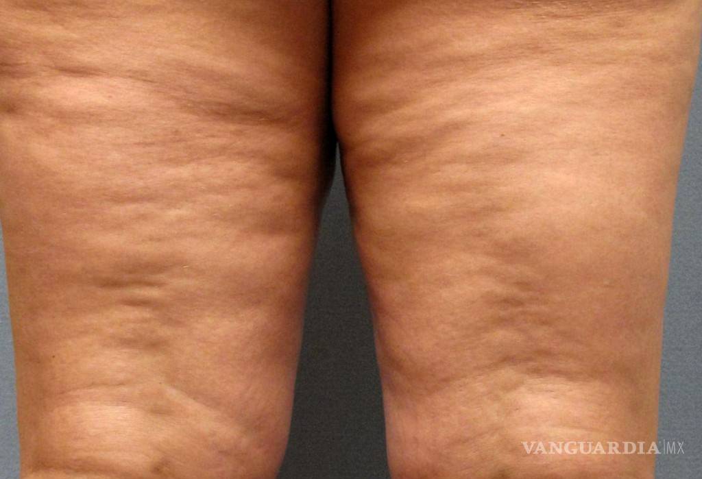 $!¿Vinagre de manzana para eliminar celulitis? Aquí te decimos cómo lograrlo