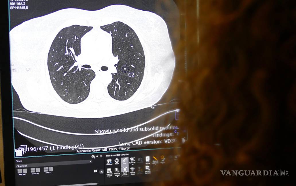 $!Imagen de una tomografía computarizada pulmonar en la que la IA muestra la presencia de un nódulo pulmonar sospechoso.