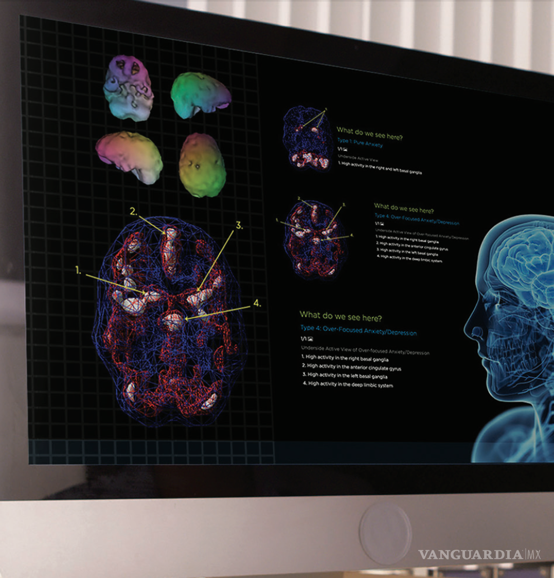 $!Exploración SPECT.