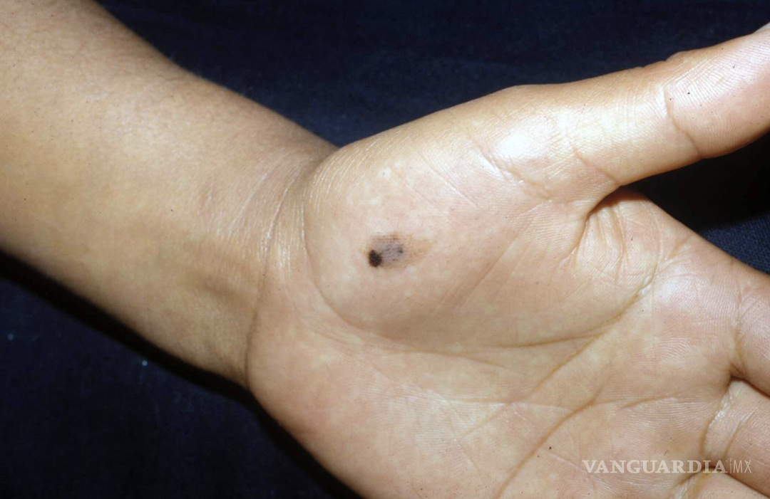 $!El melanoma acral es un tipo de cáncer de piel que aparece como una mancha irregular y oscura.