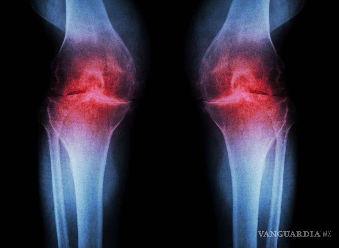 $!Cada vez más jóvenes padecen osteoartritis, por obesidad