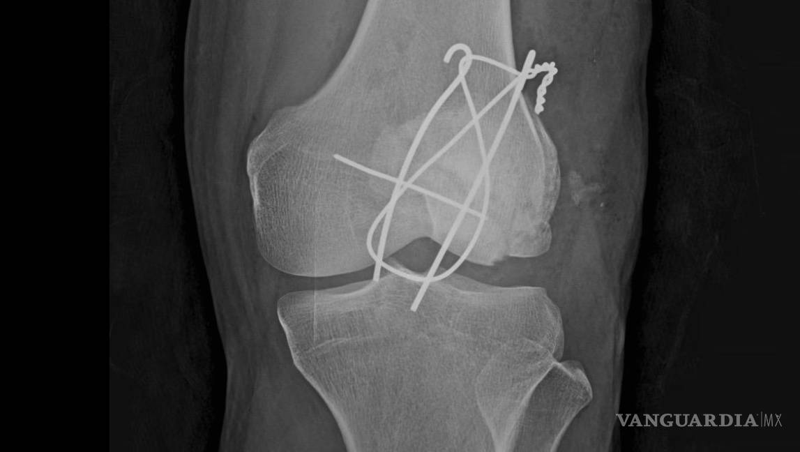 $!La drag queen Genn Taft resultó gravemente herida tras un choque en Uber Moto; acusa que el conductor se quedó dormido y que aún no recibe reembolsos médicos.