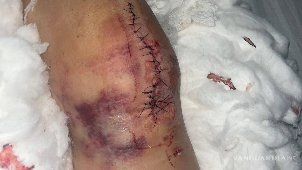 $!Genn Taft sufrió una fractura expuesta en un accidente de Uber Moto y reclama falta de apoyo económico de la plataforma y la aseguradora.