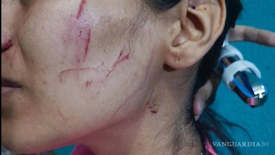 $!Imagen de las lesiones faciales de Alexa.