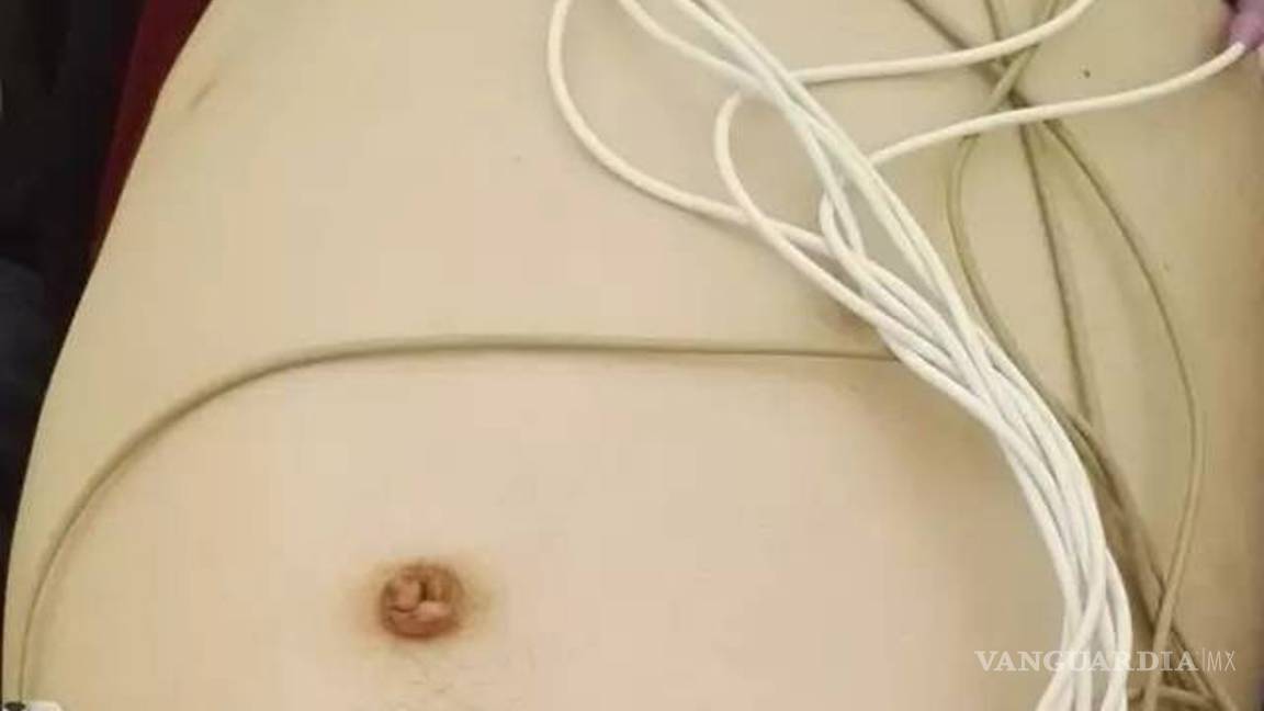 $!Retiran 13 kilos de heces de un hombre estreñido con cirugía