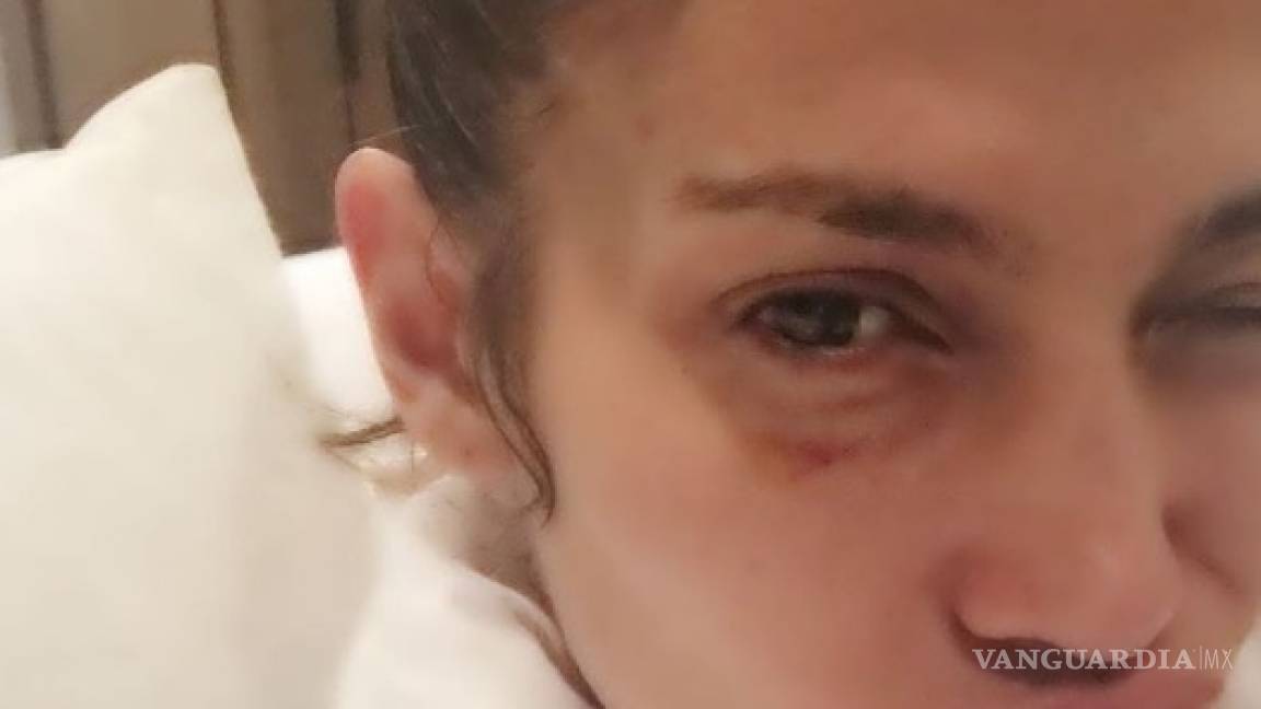 Jennifer López publica foto con el ojo morado