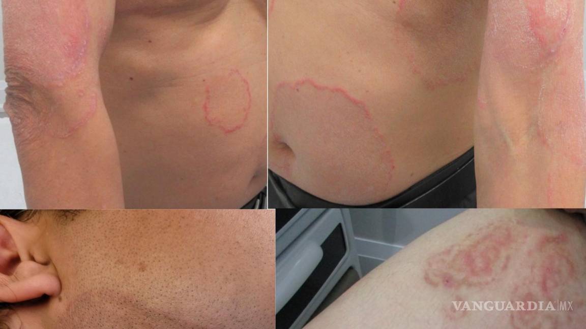 $!La dermatofitosis suele presentar escamas y color rojizo, y puede causa picazón