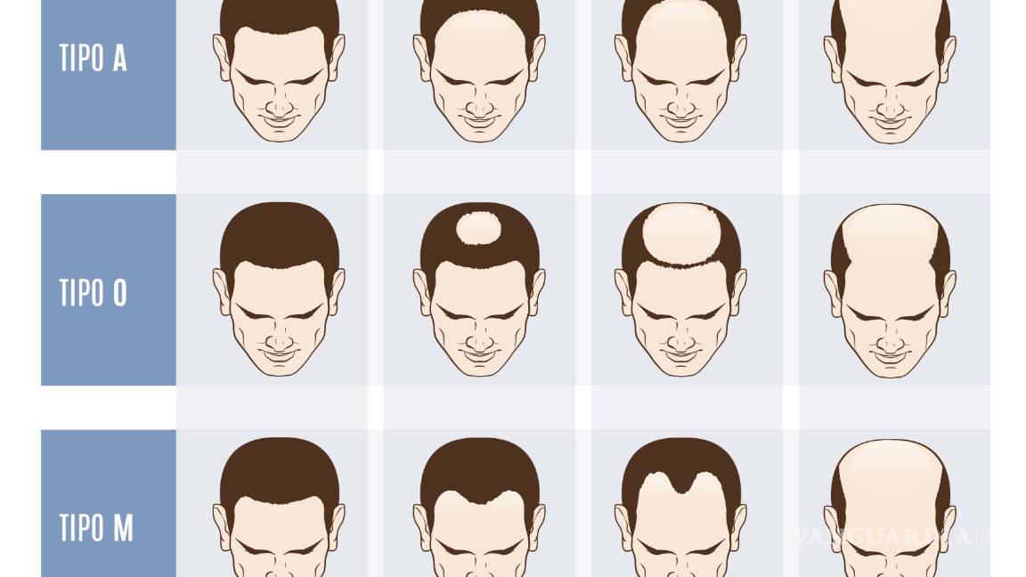 $!Calvicie: el terror en la 'azotea' que nadie quiere experimentar