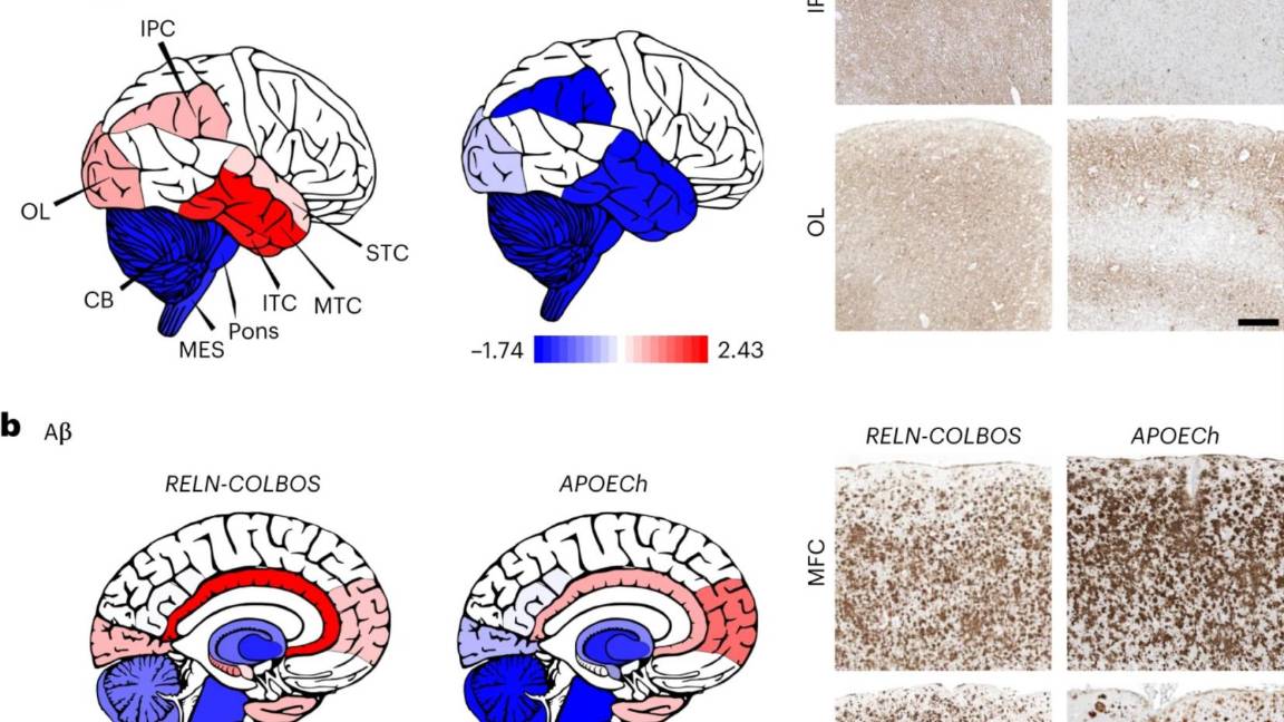 $!Distribución cerebral de las características de la EA en los casos con RELN-COLBOS y APOECh.