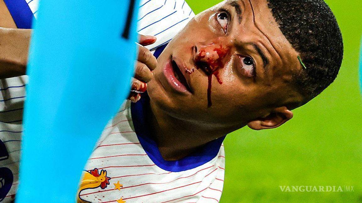 $!Mbappé sufrió una lesión en la nariz durante el encuentro.