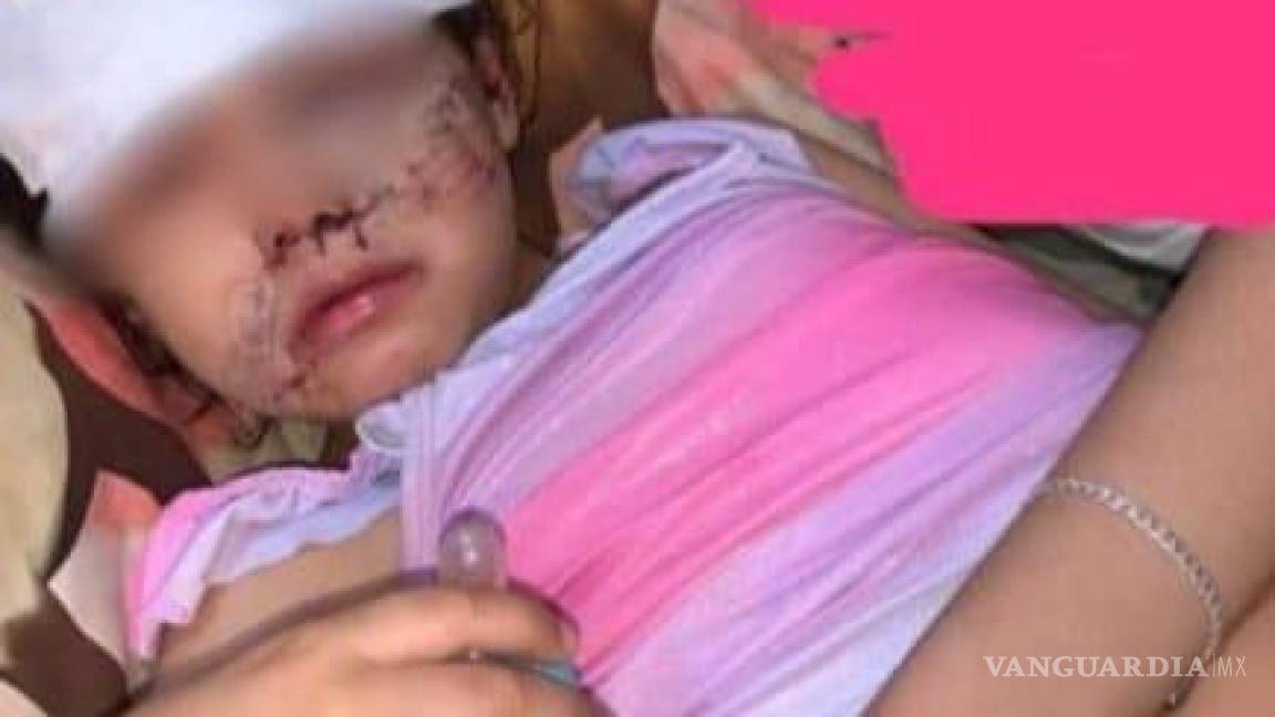 Piden apoyo para niña atacada por un perro en la colonia Nueva Merced, de Torreón