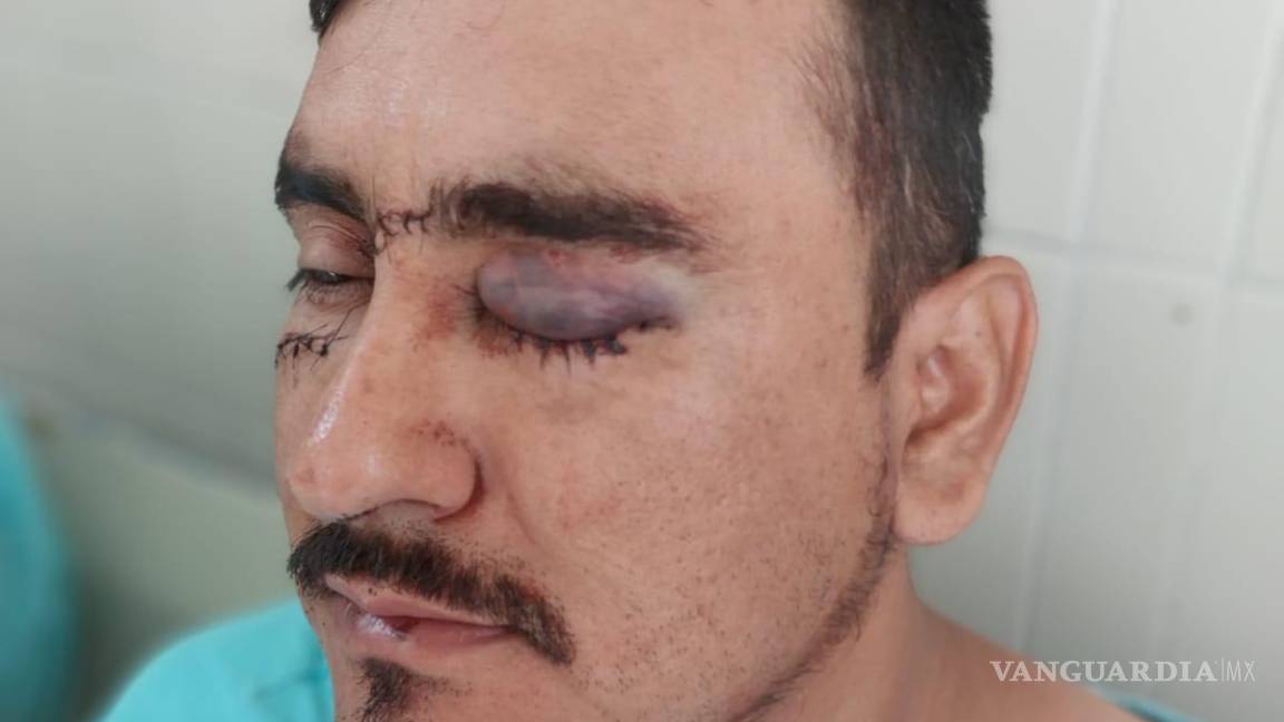 Agreden con arma blanca a castañense en aniversario del Ejido Palo Blanco; está en riesgo de perder un ojo