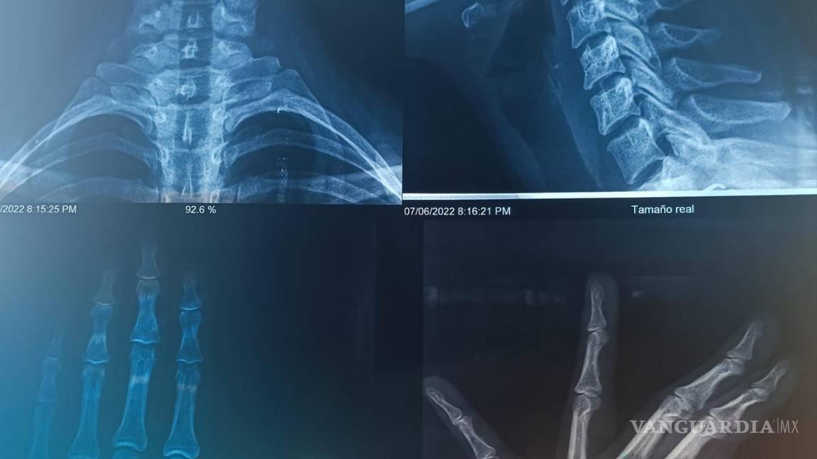 $!Imagenes de las radiografías de Alexa.