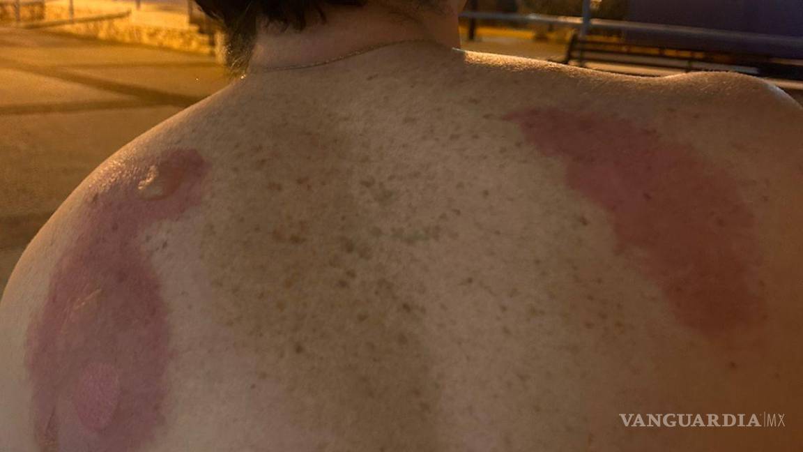 $!Algunos de los asistentes terminaron con quemaduras graves.