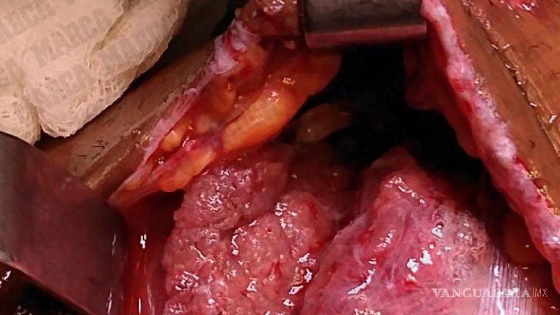 $!Estas son las imágenes de la operación de Giovani dos Santos (se recomienda discreción)