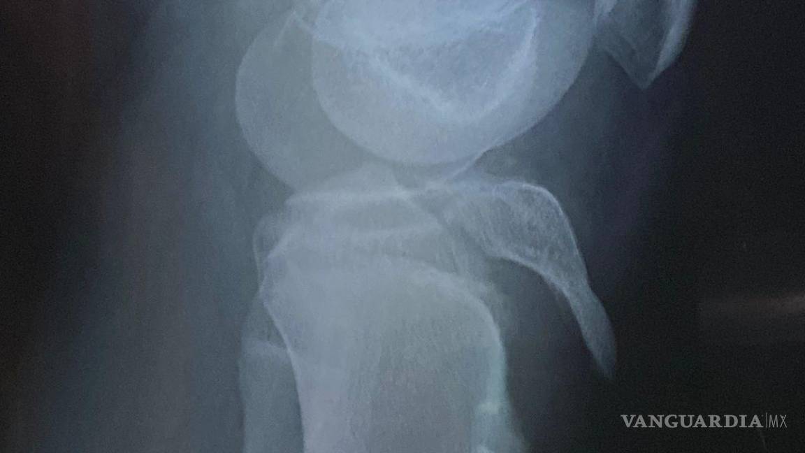 $!Padres denuncian que el colegio no siguió los protocolos de atención médica ni llamó a una ambulancia tras la lesión.